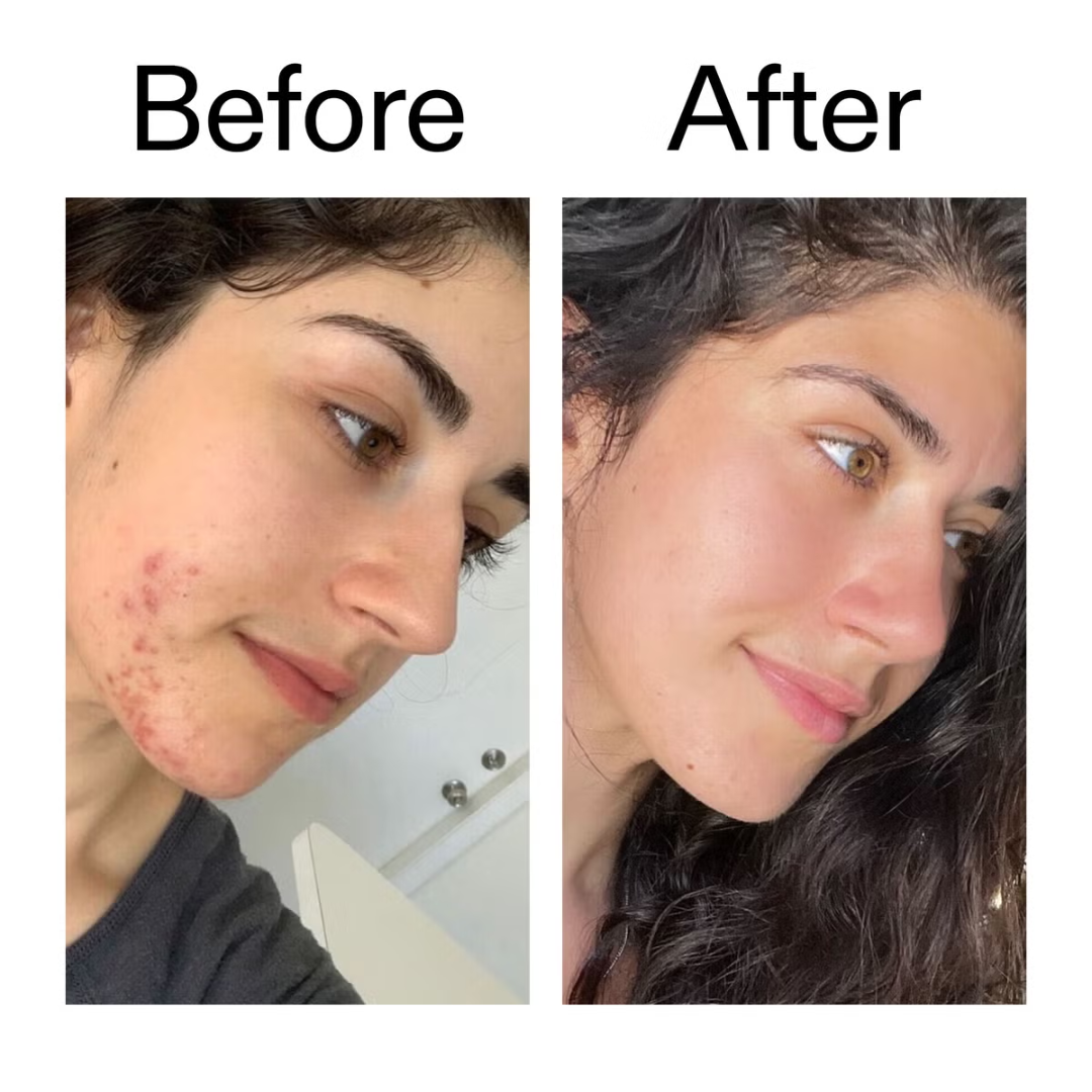 The INKEY List Acne Treatment - Succinic Acid Treatment - 15ml